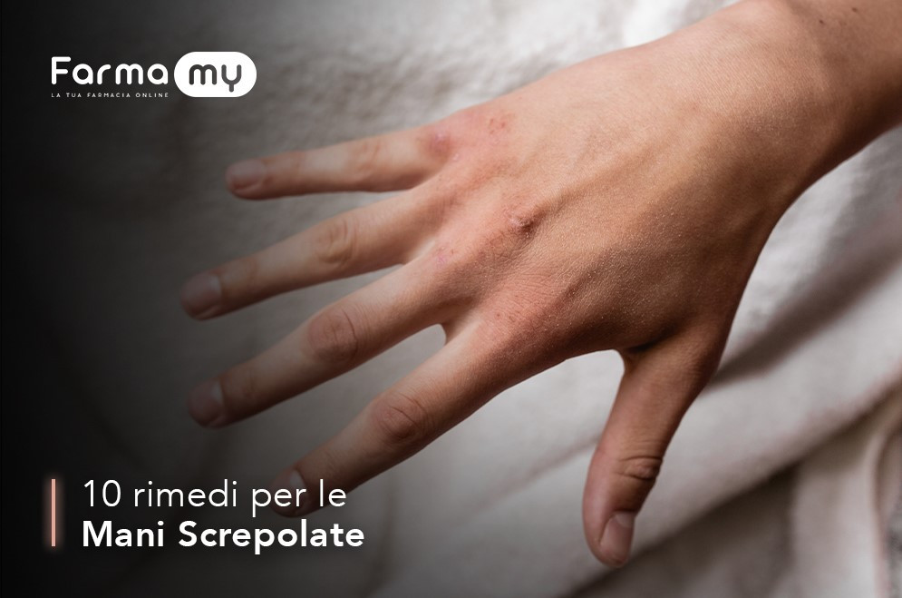 10 rimedi contro le mani screpolate